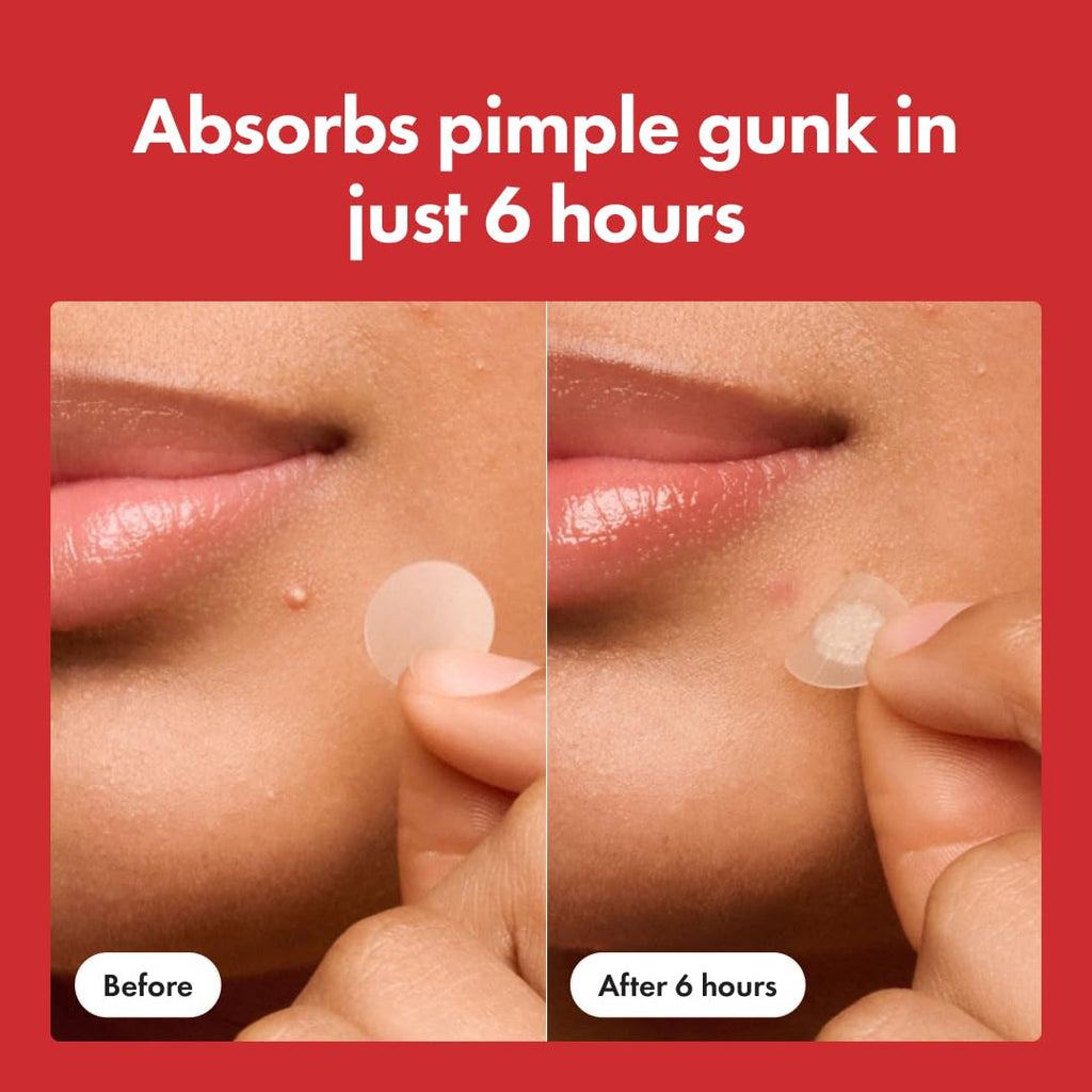 Pimple Patches
